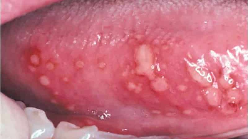 Как лечить болячку на языке