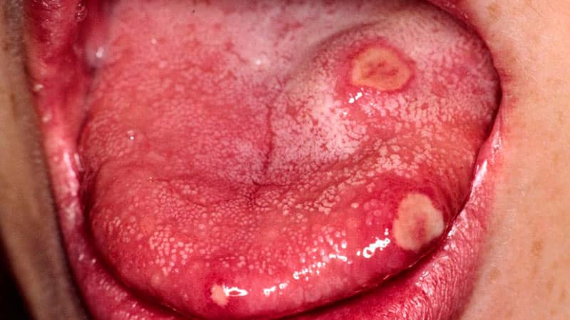 Как лечить болячку на языке