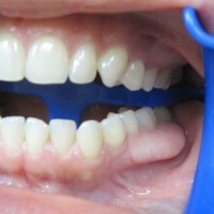 Как лечить экзостоз после удаления зуба