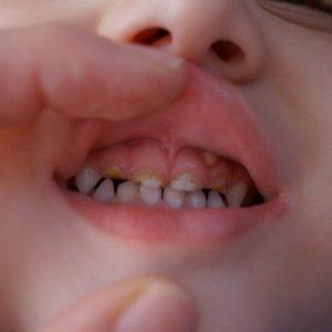 Как лечить экзостоз после удаления зуба