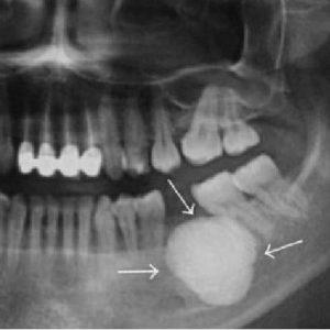 Как лечить экзостоз после удаления зуба