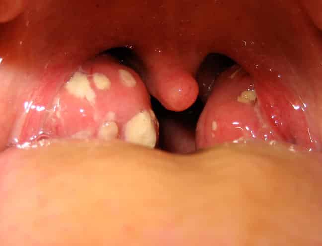 Белый гной фото на миндалинах лечение