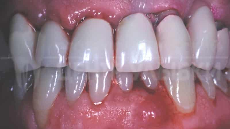 как лечить гнойник на десне