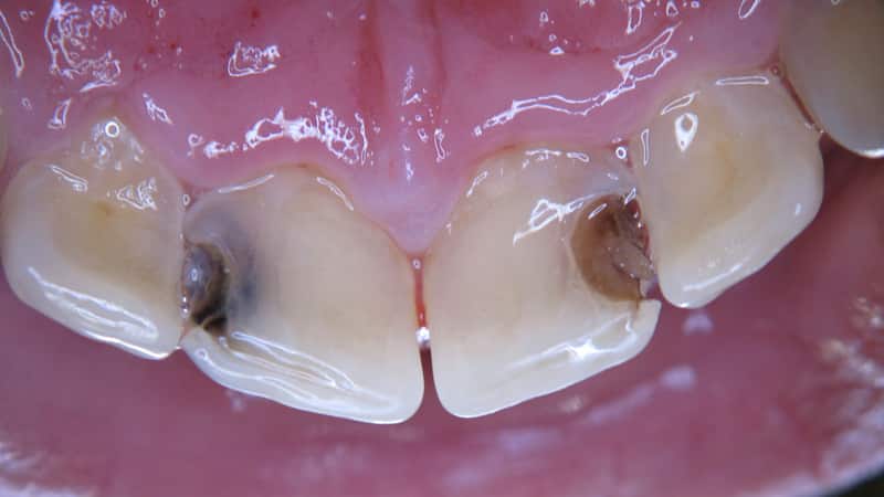 кариес между зубами фото