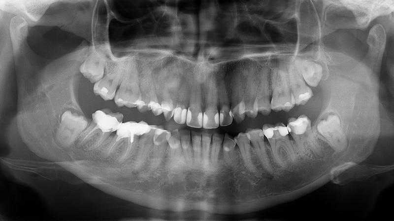 как лечить кариес между зубами