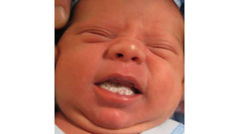 Молочница во рту у ребенка