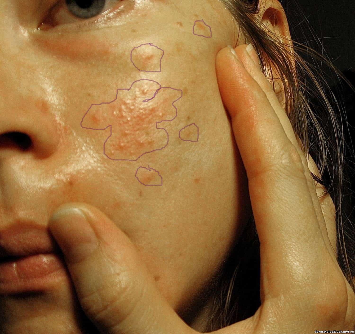 неврит тройничного нерва фото