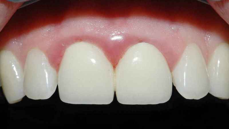 как лечить воспаление десны под коронкой