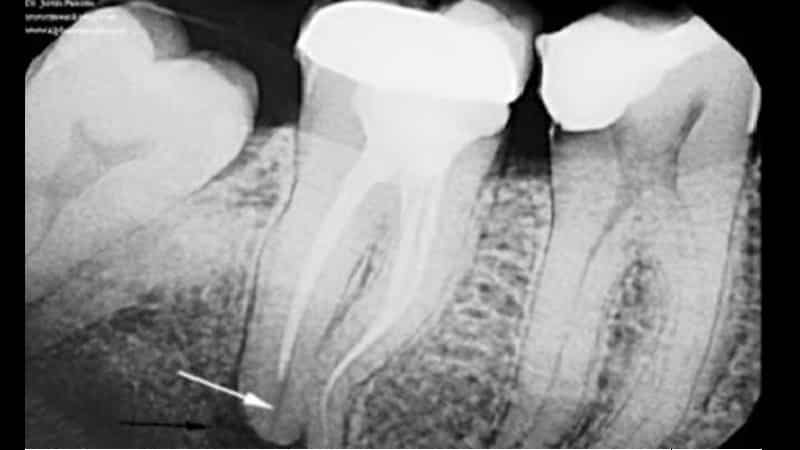 воспаление десен под протезом лечение