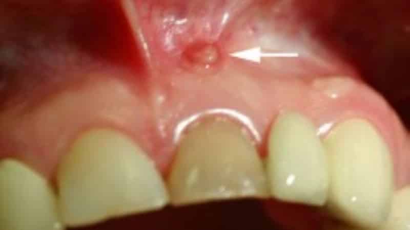 воспалилась десна под протезом что делать