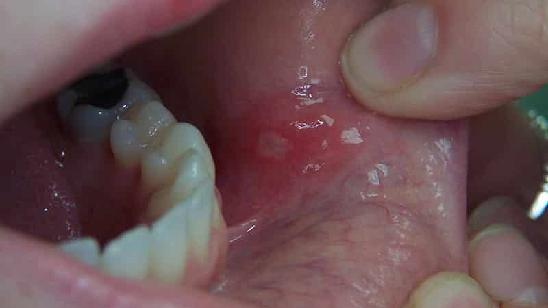 Как лечить язвы во рту