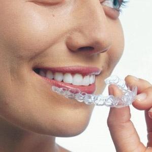 Как проходит лечение каппами Invisalign