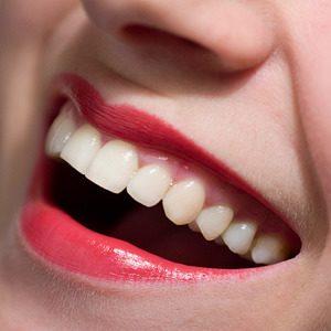 Как проходит лечение каппами Invisalign