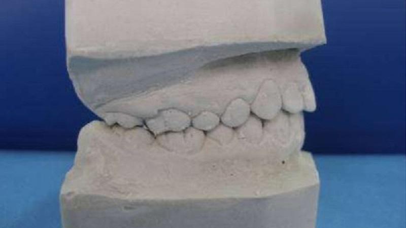 Как работать с гипсом в стоматологии