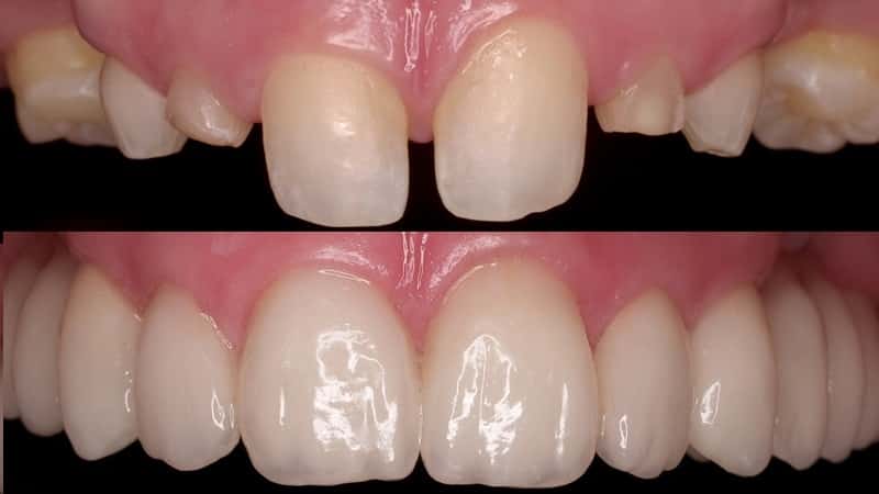 в каких случаях ставят коронку на зуб