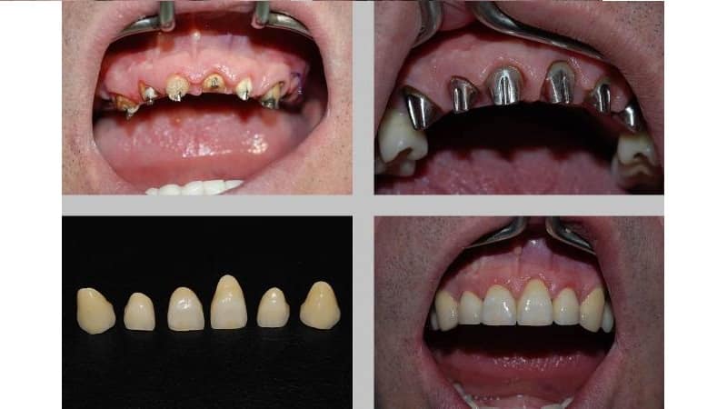 как ставят штифт в зубе что это такое фото