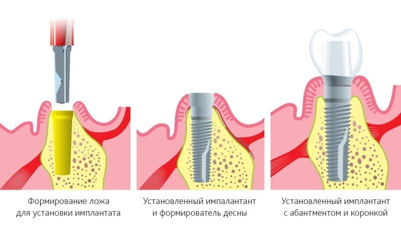 штифты для зубов фото