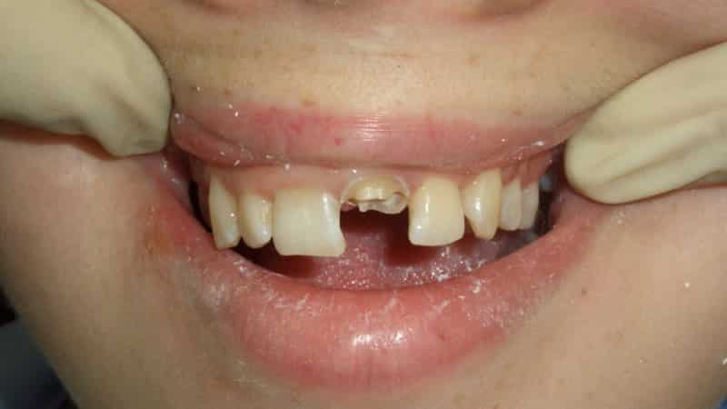 как ставят штифт в зубе