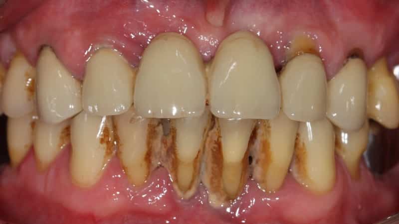 как убрать запах сигарет изо рта