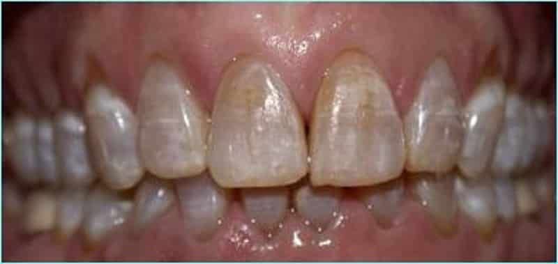 как укрепить эмаль зубов в домашних условиях народными средствами