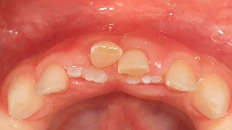 определить молочный зуб или коренной