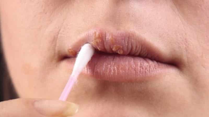 герпес под губой