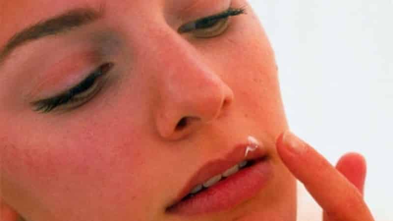 герпес на нижней губе