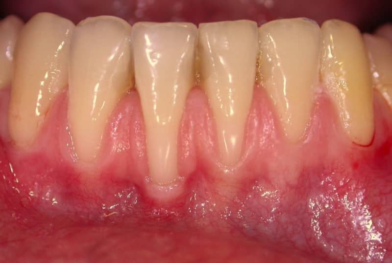 как выглядит пародонтоз фото