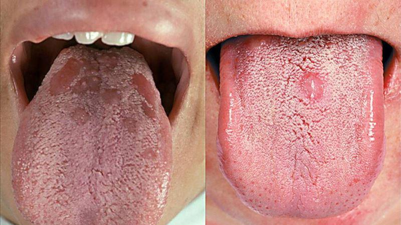 как выглядит сифилис во рту фото