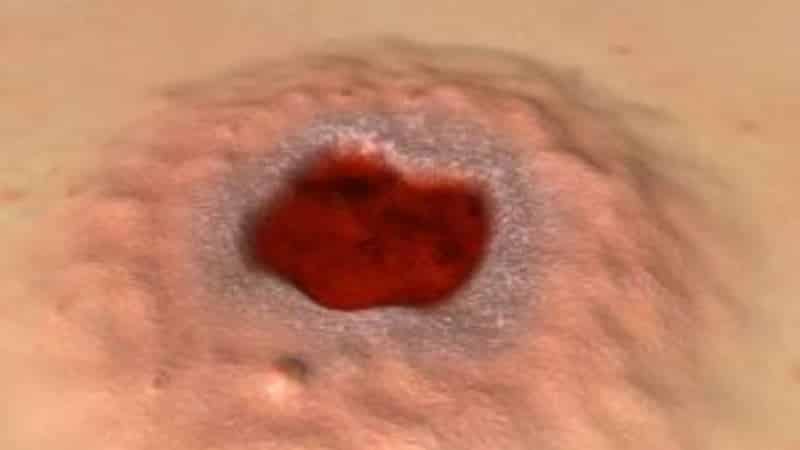 сифилис ротовой полости