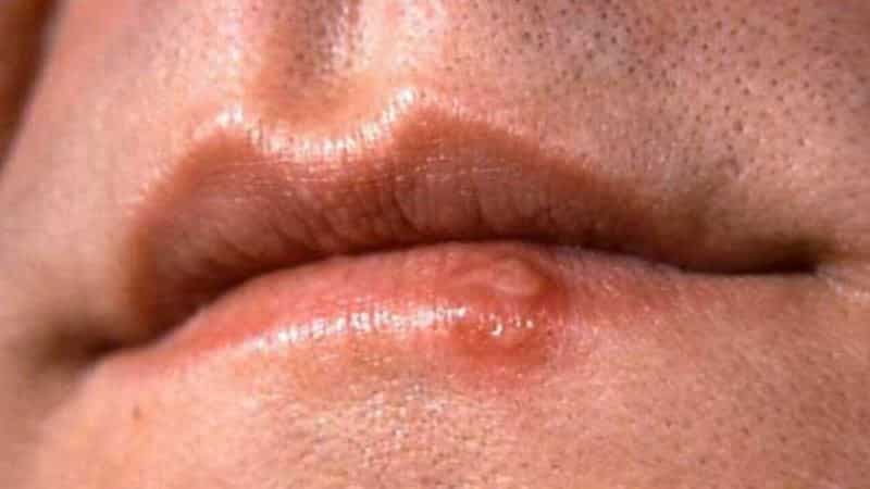 сифилис на языке фото