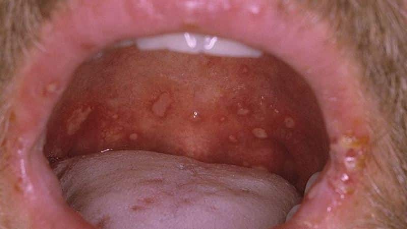 сифилис языка