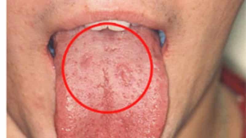 сифилис полости рта