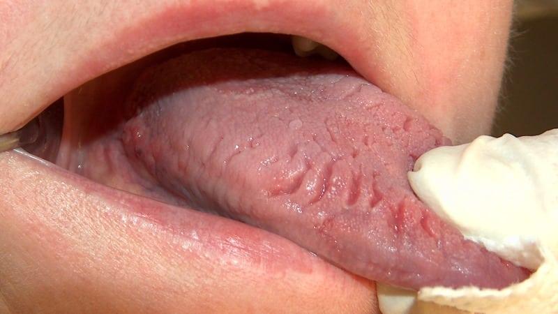 больной язык человека фото