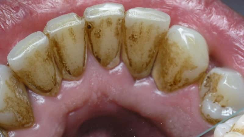 как выглядит зубной камень фото и после