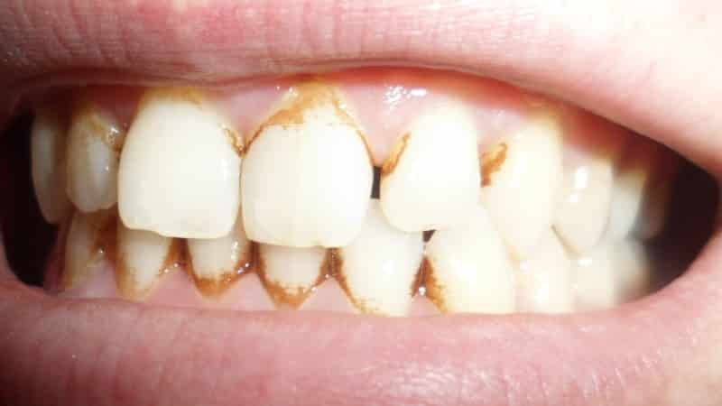 зубные камни фото