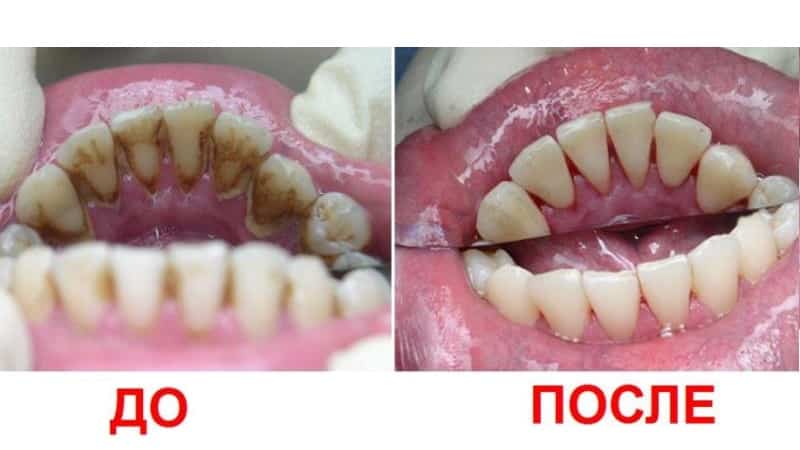 удаление зубного камня до и после фото