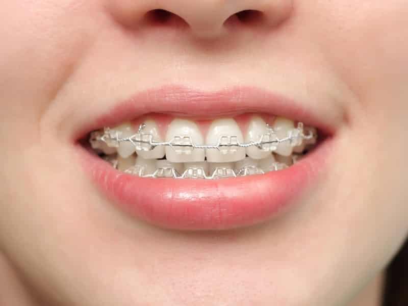 как выглядят брекеты на зубах фото