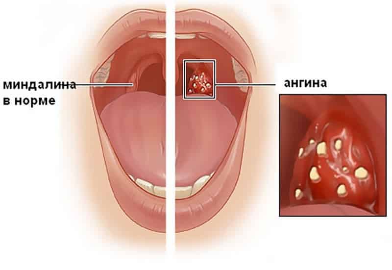 как выглядят гланды фото