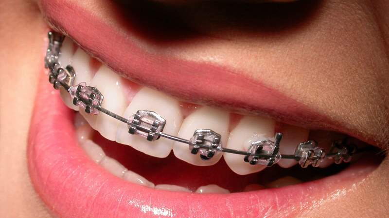 какие брекеты лучше керамические или сапфировые