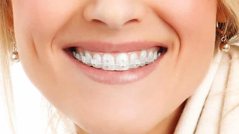 керамические или сапфировые брекеты