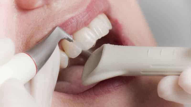 керамические и сапфировые брекеты разница