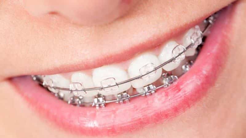 какие брекеты лучше ставить взрослому