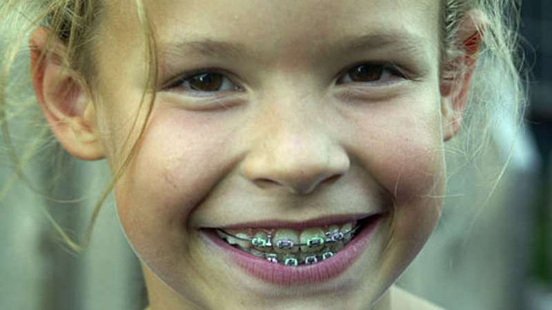 какие брекеты выбрать