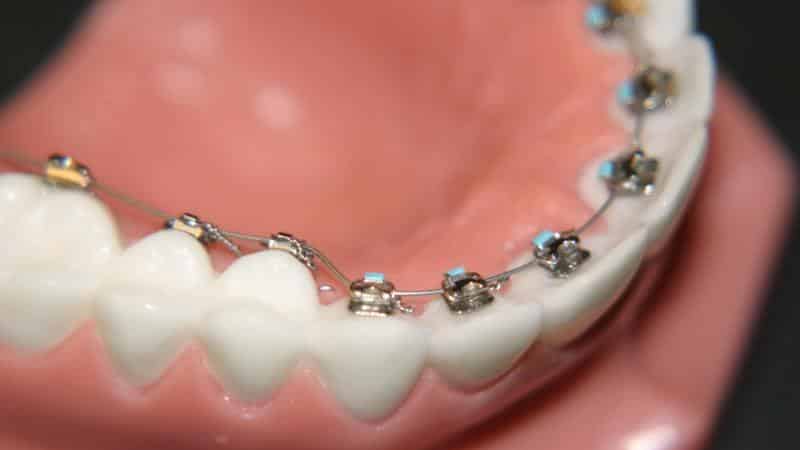 какие брекеты лучше ставить подростку отзывы