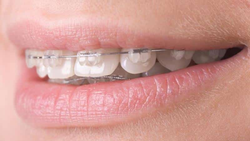 какие брекеты лучше керамические или металлические