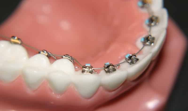 какие бывают брекеты на зубы фото