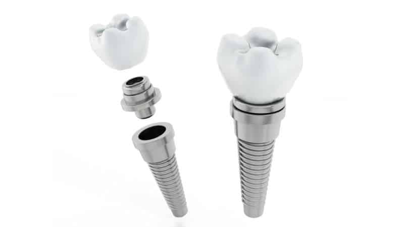 какие имплантанты зубов лучше