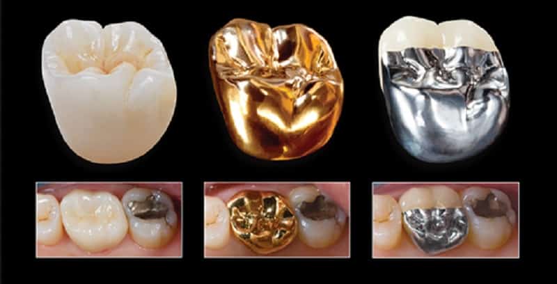 какие зубные коронки лучше для зубов