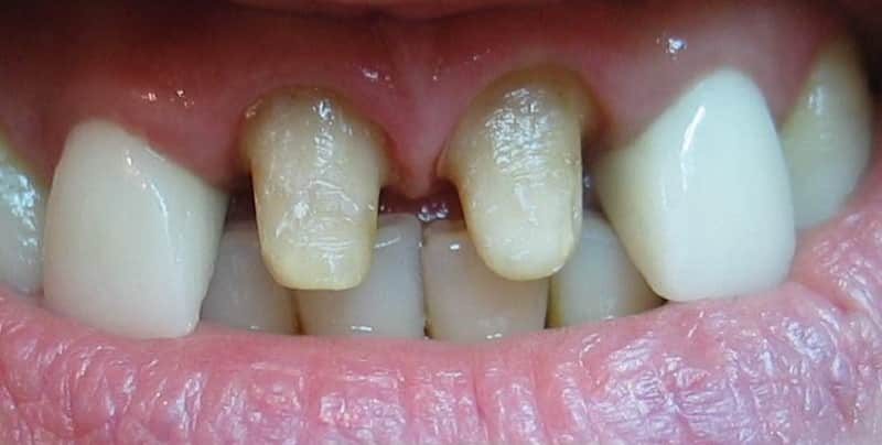 какую коронку лучше поставить на жевательные зубы